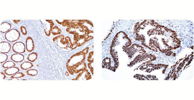 Diagnostic immunohistochemical staining Cell Marque™ IVD antibody staining of colon carcinoma