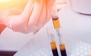 Blood Plasma Fractionation Blood Plasma Fractionation
