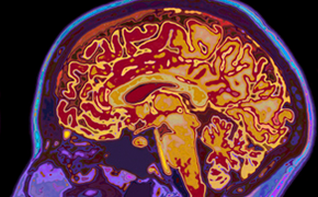 Colored MRI image of brain A detailed MRI scan of a human brain, showcasing a cross-section with various regions highlighted in bright colors such as yellow, red, and orange, set against a contrasting blue and purple background, emphasizing the complex structure and organization of the brain.
