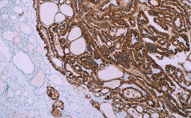 IHC staining of clinical tissue with a Cell Marque™ TROP2 antibody IHC staining of papillary thyroid carcinoma with Cell Marque™ antibody TROP2 (EP431) and counterstain