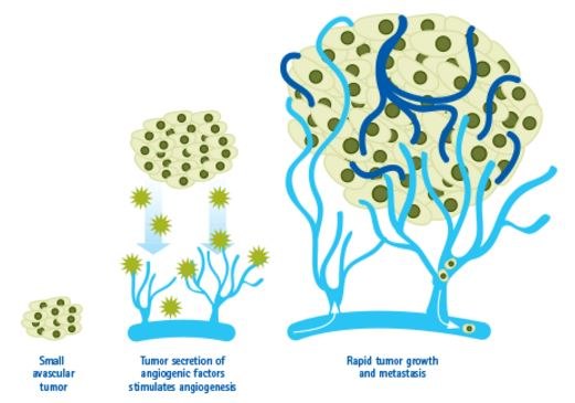Angiogenesis in Cancer Angiogenesis in Cancer