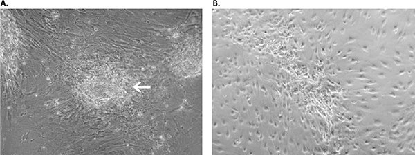 A) During the first two weeks of the isolation process, the cancer cells appeared as locally restricted, lightly-adherent convex cell clusters (white arrow) on top of the stroma layer. B) After 4 weeks, highly motile cancer cells began migrating from their original locations to cover the whole culture surface. These cells proliferated as a homogeneous population in the Primary Cancer Cell Medium D-ACF. Primary culture derived from an invasive adenocarcinoma with the Primary Cancer Culture System