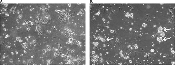 A) Culture on day 2 after initial plating: a mix of residual erythrocytes, fibroblast- and epithelial-like adherent cells as well as floating single suspension cells can be observed. B) On day 11, the formation of floating multicellular cell aggregates is already prominent (white arrows). The culture was used for primary aggregate separation on day 13 and was additionally cultured in a new flask parallel to the original sample containing the remaining adherent cell fraction. Appearance of primary culture of lung squamous cell carcinoma cells in the Primary Cancer Cell Medium D-ACF in early stages.
