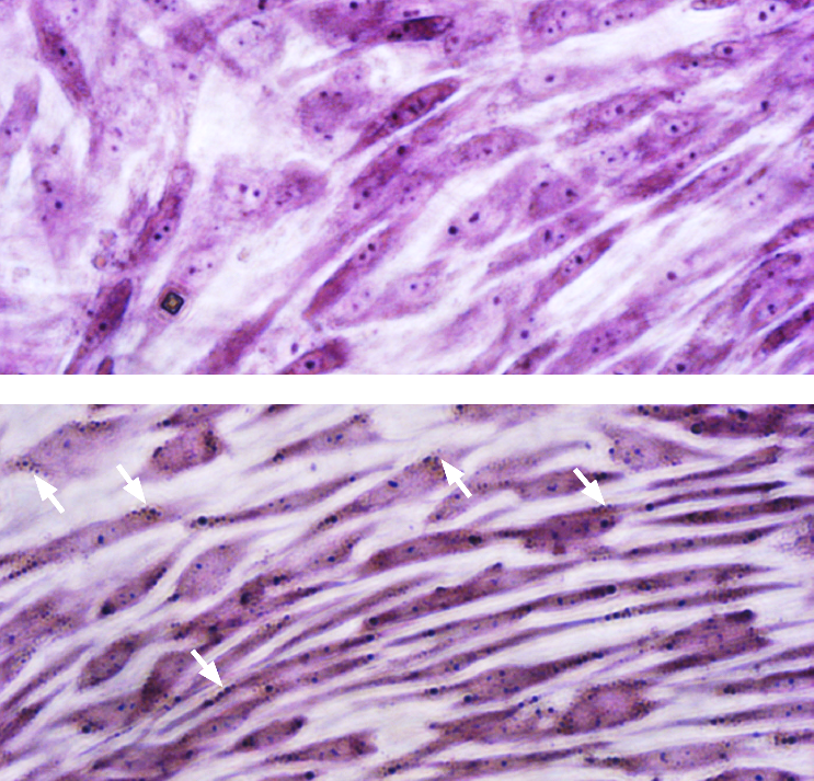 Cells were cultured for 3 days in PromoCell MSC Growth Medium 2 for the negative control (top panel) or MSC Neurogenic Differentiation Medium for the differentiation sample (bottom panel). In contrast to the negative control, the neuronal cells differentiated from MSC show extensive somata-associated accumulations of Nissl bodies stained dark black-violet (white arrows). Nissl body staining of hMSC-BM derived neuron-like cells