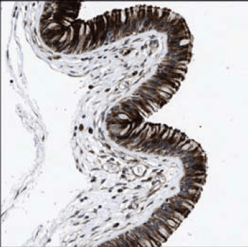 Immunohistochemical staining of human nasopharynx shows cytoplasmic and membranous positivity in respiratory epithelial cells using Prestige Antibodies® Anti-DEFA5 (Cat. No. HPA015775) Immunohistochemical staining of human nasopharynx shows cytoplasmic and membranous positivity in respiratory epithelial cells using Prestige Antibodies® Anti-DEFA5 (Cat. No. HPA015775)