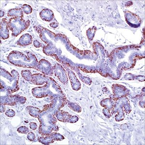 Calponin (CALP) on adenosis of breast Calponin (CALP) on adenosis of breast