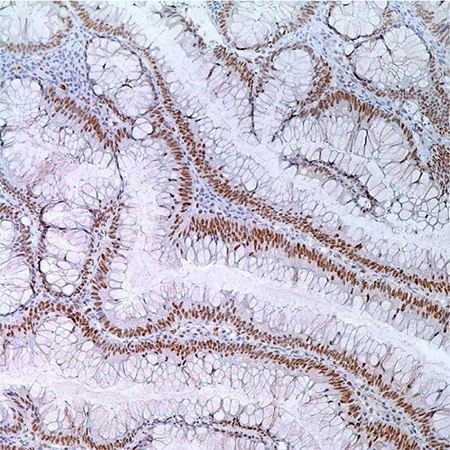 MLH1 (G168-728) in colonic adenoma in 55 year old male; nuclear labeling of adenoma cells MLH1 (G168-728) in colonic adenoma in 55 year old male; nuclear labeling of adenoma cells