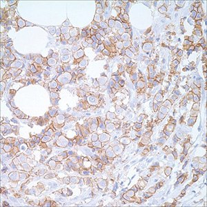 E-cadherin (EP700Y) on breast carcinoma E-cadherin (EP700Y) on breast carcinoma