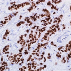 GATA3 (L50-823) on infiltrating ductal carcinoma of the breast GATA3 (L50-823) on infiltrating ductal carcinoma of the breast