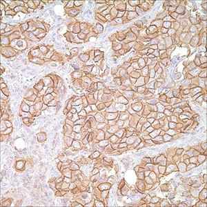Her2/Neu (c-erB-2) (CB-11) on breast carcinoma Her2/Neu (c-erB-2) (CB-11) on breast carcinoma