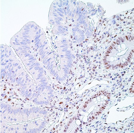 PMS2 (EPR3947†)– Note the normal nuclear labeling of the crypt epithelial cells  PMS2 (EPR3947†)– Note the normal nuclear labeling of the crypt epithelial cells