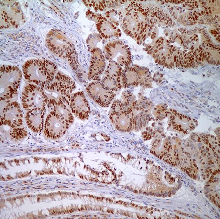 MSH6 (44) - nuclear labeling of adenocarcinoma cells and normal crypt epithelial cells. MSH6 (44) - nuclear labeling of adenocarcinoma cells and normal crypt epithelial cells.