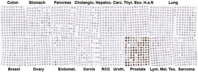 Representation of TMA cohort Representation of TMA cohort