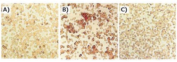 Incorporation of transferrin decreases erythrocyte aggregation Incorporation of transferrin decreases erythrocyte aggregation