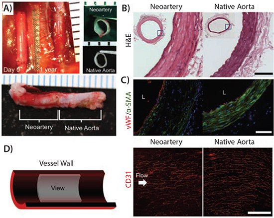 Gross morphology and tissue architecture of neoarteries resemble native arteries. A) Top left: transformation of graft into neoartery in situ over the course of 1 year. Nondegradable sutures (black) mark the graft location. Top right: Transverse view of explanted neoarteries resembles that of native aortas. Bottom: Longitudinal view of explanted neoarteries resembles the adjacent native aorta. All ruler ticks are 1 mm. B) H&E stained transverse sections of the middle of neoarteries show similar tissue architecture with native aortas, with no visible graft material residues. Scale bar 100 mm. C) Neoartery sections immunostained for von Willebrand factor (vWF, red) and α-smooth muscle actin (α-SMA, green). The luminal surface of neoarteries is completely covered by vWF positive cells (red), suggesting a confluent endothelium. Neoarteries contain a media-like middle layer of the vascular wall rich in α-SMA positive cells with circumferentially elongated nuclei, similar to vascular smooth muscle found in native aortas. The outermost layer of neoarteries lacks α-SMA, resembling native adventitia. Some cells in the media-like layer are negative for α-SMA, and some cells adjacent to the endothelium are α-SMA positive but not circumferentially elongated. Scale bar 100 mm. L indicates vessel lumen. Nuclei stained with DAPI (blue). D) En face view of the luminal surface of neoarteries shows complete coverage by CD31 positive cells with cobblestone-like morphology and alignment parallel to the direction of blood flow, an arrangement similar to that found in native aortas. Neoarteries were cut open longitudinally and imaged as whole mounts using confocal microscopy and z-stack flattening. Arrow indicates the direction of blood flow. Scale bar 100 mm. Reprinted by permission from Reference 13. Copyright 2013, Elsevier Ltd. Gross morphology and tissue architecture of neoarteries resemble native arteries