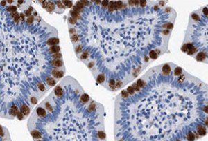 Immunoperoxidase staining of formalin-fixed, paraffin-embedded human small intestine shows strong intracellular proteinaceous material positivity in glandular cells Immunoperoxidase staining of formalin-fixed, paraffin-embedded human small intestine shows strong intracellular proteinaceous material positivity in glandular cells