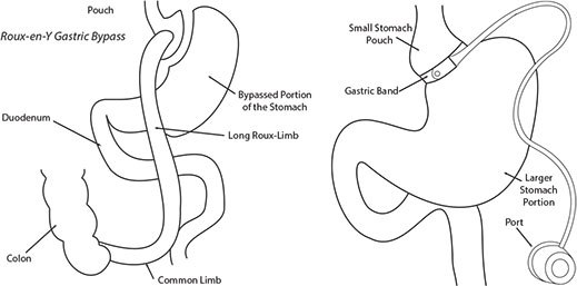 Fast and Robust HPLC Separation of Bile Acids and Conjugates with Ascentis Express C18 Roux-en-Y Gastric Bypass and Gastric Banding