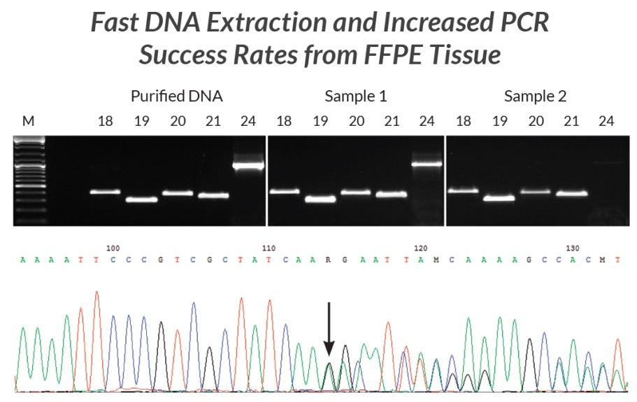 DNA extracts were prepared from two different FFPE samples using KAPA Express Extract. Each extract was used directly (without quantification) in multiple PCRs containing KAPA2G Robust HotStart ReadyMix and primers for five different fragments (293 bp – 1 kb) of the EGFR gene (corresponding to exons 18 – 21 and 24). Results were compared to those obtained using the same reaction and cycling conditions but using 1 ng purified human genomic DNA as template. With the exception of the 1 kb exon 24 fragment from the older sample, yields and reaction efficiencies were comparable between the FFPE DNA extracts and purified genomic DNA. The PCR products generated from sample 1 were diluted 1:10 and used directly in standard Sanger sequencing reactions. Sequence data (bottom panel, Sample 1 exon 19 fragment) was of a high quality. The mixed sequence starting at the position marked with the arrow confirmed the presence of a 15-nt deletion associated with non-small cell carcinoma diagnosed in the patient from whom Sample 1 was collected. DNA extracts were prepared from two different FFPE samples using KAPA Express Extract.