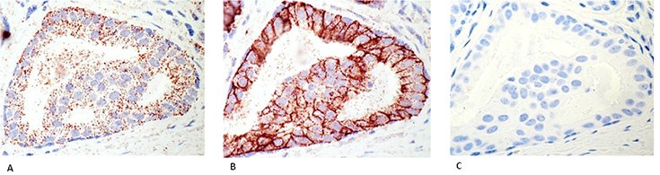 Detection of HER2 receptor and HER2/HER3 heterodimers in FFPE breast cancer tissue Detection of HER2 receptor and HER2/HER3 heterodimers in FFPE breast cancer tissue