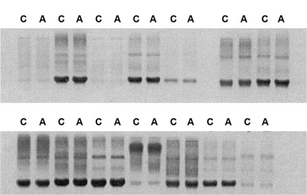 Results of electrophoretic resolution of free immunoglobulin light chains (Bence-Jones proteins) in urine samples concentrated using Centricon® (C) and Amicon® Ultra (A) centrifugal concentration devices. The dark bands at ~25 kDa in each lane represent these proteins. Results of electrophoretic resolution of free immunoglobulin light chains