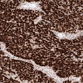Anti-WT1 antibody produced in mouse Prestige Antibodies&#174; Powered by Atlas Antibodies, clone CL13165, purified by using Protein A, buffered aqueous glycerol solution
